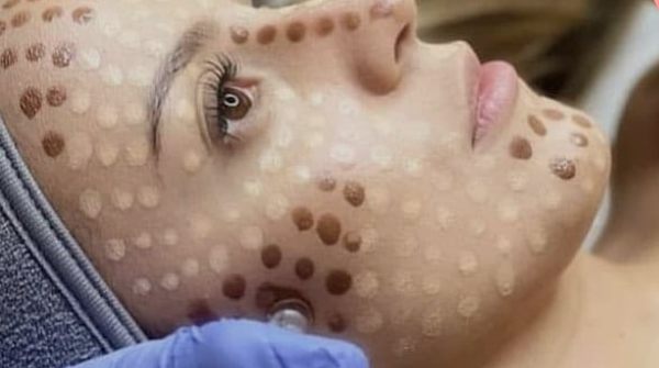 BB glow treatment
